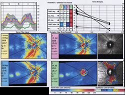 Typical RNFL findings in LHON. A 20-year-old male in a different family presented in May 2008 with reduced vision in his right eye for at least several weeks. Genetic analysis confirmed LHON (also with the 11778 pt mutation). 