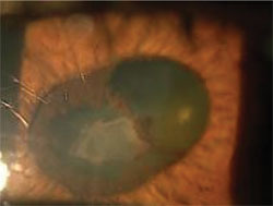 Left eye, fibrin debris with synechiae.