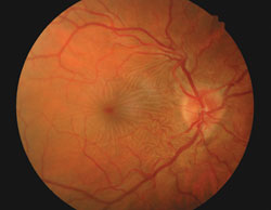 Fundus examination of the right eye (top) showed grade 2 edema and mild hyperemia of the optic nerve head with a 0.15 round cup-to-disc ratio. Choroidal folds and retinal wrinkling were noted temporal to the disc. The posterior pole was normal in the left eye.