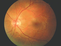 Fundus examination of the right eye (top) showed grade 2 edema and mild hyperemia of the optic nerve head with a 0.15 round cup-to-disc ratio. Choroidal folds and retinal wrinkling were noted temporal to the disc. The posterior pole was normal in the left eye.