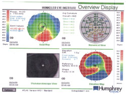 The images show inferior corneal steepening and high against-the-rule astigmatism in both eyes, which is consistent with keratoconus.