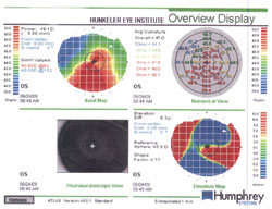 The images show inferior corneal steepening and high against-the-rule astigmatism in both eyes, which is consistent with keratoconus.