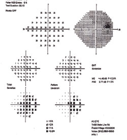 The right eye (top) showed an enlarged blind spot; the left eye appeared normal.