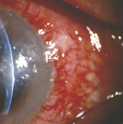 Mycobacterium corneal ulcer. Immunocompromised patients can experience mycobacterial infections. 