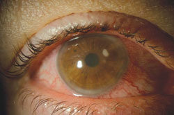 Staphylococcal corneal ulcer. Many clinicians consider Staphylococcus to be the No. 1 pathogen. 