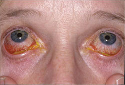 This patient has a classic presentation of mucopurulent discharge that is pathognomonic of an ocular surface bacterial infection. Note that a red eye with no discharge indicates an inflammatory conjunctivitis, not one of infectious origin.