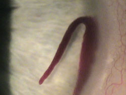 Serpentine blood clot