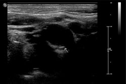 Carotid Doppler ultrasonography in this patient. A few atheromatous plaques are seen in the right carotid bulb and bilateral proximal ICA. There is no hemodynamically significant stenosis on either side.