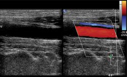 Carotid Doppler ultrasonography in this patient. A few atheromatous plaques are seen in the right carotid bulb and bilateral proximal ICA. There is no hemodynamically significant stenosis on either side.