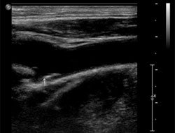 Carotid Doppler ultrasonography in this patient. A few atheromatous plaques are seen in the right carotid bulb and bilateral proximal ICA. There is no hemodynamically significant stenosis on either side.