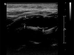 Carotid Doppler ultrasonography in this patient. A few atheromatous plaques are seen in the right carotid bulb and bilateral proximal ICA. There is no hemodynamically significant stenosis on either side.