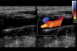 Carotid Doppler ultrasonography in this patient. A few atheromatous plaques are seen in the right carotid bulb and bilateral proximal ICA. There is no hemodynamically significant stenosis on either side.