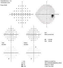  The 24-2 visual field revealed a superior altitudinal scotoma in the left eye. 