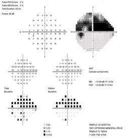  The 24-2 visual field revealed a superior altitudinal scotoma in the left eye. 