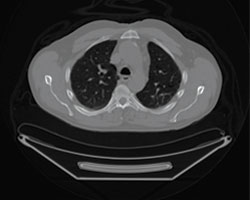 The PET/CT scans for this patient show a solitary focus of abnormal hypermetabolic activity that may correspond to an atherosclerotic inflammation vs. an adjacent subcentimeter aortocaval lymph node at the level of the right renal vein. There are no additional abnormal regions of hypermetabolic activity that indicate malignancy. The CT shows several subcentimeter lymph nodes in the mediastinum that have essentially remained stable in size when compared to the prior CT. Follow-up imaging may offer further clarification with regard to the aorotocaval finding.