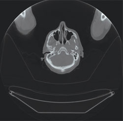 The PET/CT scans for this patient show a solitary focus of abnormal hypermetabolic activity that may correspond to an atherosclerotic inflammation vs. an adjacent subcentimeter aortocaval lymph node at the level of the right renal vein. There are no additional abnormal regions of hypermetabolic activity that indicate malignancy. The CT shows several subcentimeter lymph nodes in the mediastinum that have essentially remained stable in size when compared to the prior CT. Follow-up imaging may offer further clarification with regard to the aorotocaval finding.