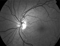 The left eye revealed two whitish areas in the inferior perimacular area.