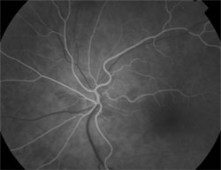 Early phase shows fluorescein angiography.