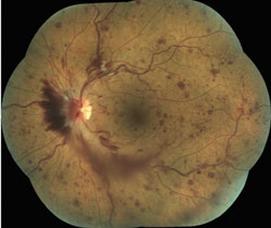 Central retinal vein occlusion