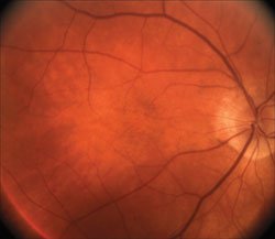 Ophthalmic findings such as dry AMD, pictured here, can serve as a springboard to a discussion of smoking cessation. 