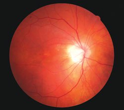 This 58-year-old patient complained of reduced vision 5 years earlier. He had a history of smoking one pack per day for 24 years. Early retinal pigment epithelium changes were evident as well as thinning on the ocular coherence tomography image. The patient was counseled regarding smoking cessation therapy and successfully completed the program with no regression. Nutritional therapy was prescribed without beta carotene. Retinal findings have been stable, but cataract formation has progressed in the 5 years of follow-up.