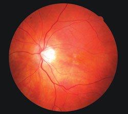 This 58-year-old patient complained of reduced vision 5 years earlier. He had a history of smoking one pack per day for 24 years. Early retinal pigment epithelium changes were evident as well as thinning on the ocular coherence tomography image. The patient was counseled regarding smoking cessation therapy and successfully completed the program with no regression. Nutritional therapy was prescribed without beta carotene. Retinal findings have been stable, but cataract formation has progressed in the 5 years of follow-up.