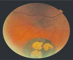 Peripheral posterior pole of the right eye. 