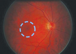 The circle indicates the expected zone of hydroxychloroquine toxicity. 