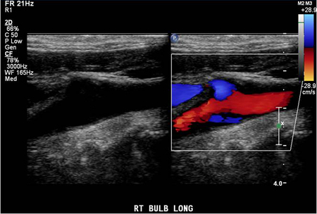 A tiny amount of hard plaque was seen in the posterior wall of the carotid bulb and perhaps also at the origin of the right internal carotid artery.