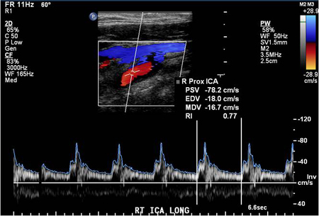 A tiny amount of hard plaque was seen in the posterior wall of the carotid bulb and perhaps also at the origin of the right internal carotid artery.