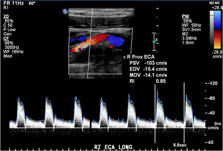 A tiny amount of hard plaque was seen in the posterior wall of the carotid bulb and perhaps also at the origin of the right internal carotid artery.