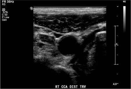 A tiny amount of hard plaque was seen in the posterior wall of the carotid bulb and perhaps also at the origin of the right internal carotid artery.