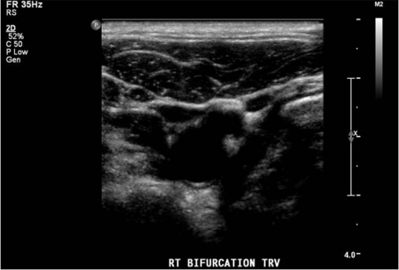 A tiny amount of hard plaque was seen in the posterior wall of the carotid bulb and perhaps also at the origin of the right internal carotid artery.