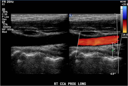 A tiny amount of hard plaque was seen in the posterior wall of the carotid bulb and perhaps also at the origin of the right internal carotid artery.