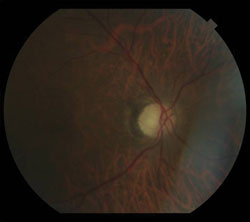 No hemorrhages or exudates were seen in either eye.