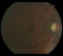 No hemorrhages or exudates were seen in either eye.