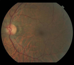 No hemorrhages or exudates were seen in either eye.