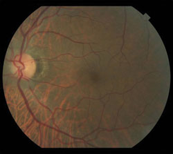 No hemorrhages or exudates were seen in either eye.