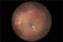 This patient with proliferative diabetic retinopathy in the left eye had a BMI of 34 kg/m2 and hemoglobin A1C of 12%.