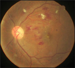 This patient with grade 3 hypertensive retinopathy had a BMI of 35 kg/m2 and blood pressure of 170/115 mm Hg.