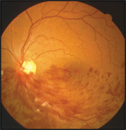 This patient with ischemic hemispheric retinal vein occlusion had a BMI of 37 kg/m2, blood pressure of 158/98 mm Hg, no history of diabetes and smoked a pack of cigarettes a day.