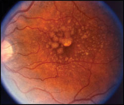 This patient with dry AMD had a BMI of 35 kg/m2.