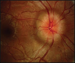 This 25-year-old female with pseudotumor cerebri had a BMI of 38 kg/m2.