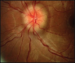 This 25-year-old female with pseudotumor cerebri had a BMI of 38 kg/m2.