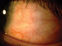 The slit lamp examination revealed clean and clear lids and lashes in both eyes. Conjunctival assessment showed raised plaques on the temporal bulbar conjunctiva with no limbal involvement.