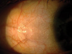 The slit lamp examination revealed clean and clear lids and lashes in both eyes. Conjunctival assessment showed raised plaques on the temporal bulbar conjunctiva with no limbal involvement.