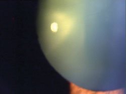 Nuclear sclerotic cataract