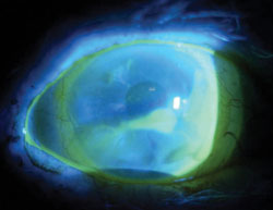 The patient was fit with a 15-mm Jupiter mini-scleral gas-permeable lens in an effort to  create a fluid reservoir to protect the epithelium and limbal stem cells from mechanical insult.