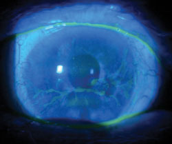 After several weeks, all topical treatments were discontinued. At this time, slit lamp exam revealed stromal thinning.