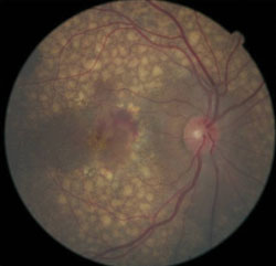 The right (top) and left (bottom) eyes of a 57-year-old African American woman with 20/200 OD and 20/60 OS visual acuity.